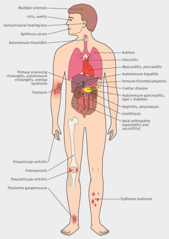 extraintestinal manifestations of ibd